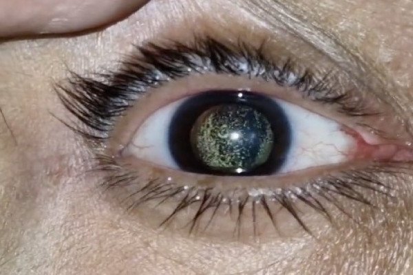 Hialosis asteroidea : une condition qui transforme vos yeux en galaxies scintillantes